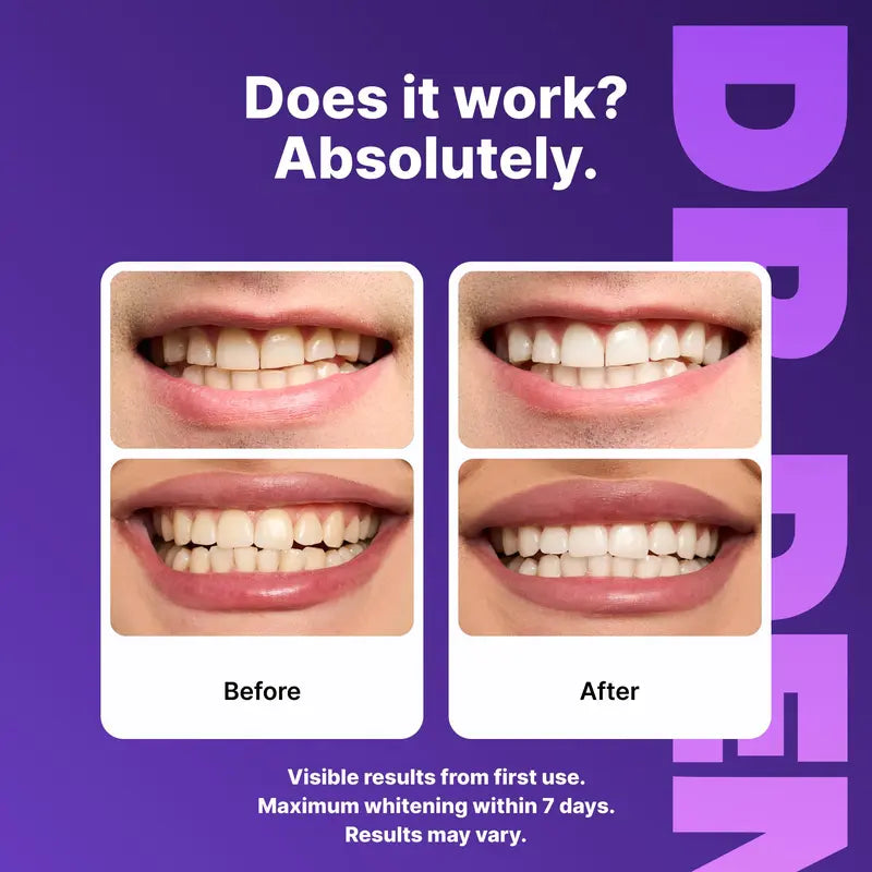 PureSmile Whitening Strips – Brighter Smile in Days